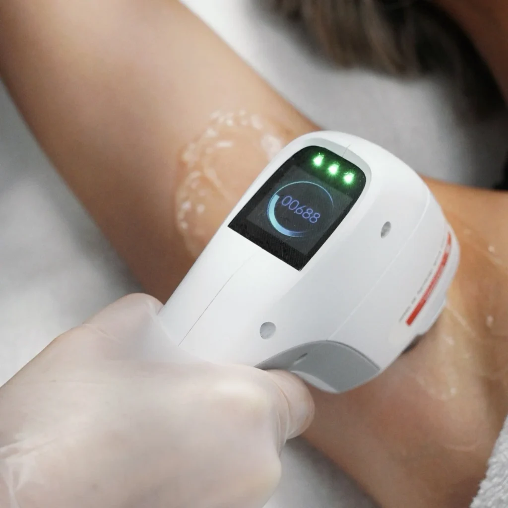 Close-up of advanced triple-wavelength laser technology in action during a professional hair removal session at The Laser Base.