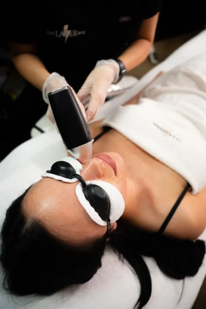 PCOS and laser hair removal